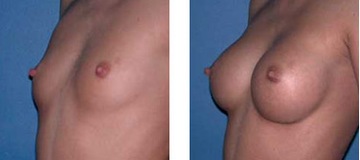 BREAST FAST ТАБЛЕТКИ ДЛЯ УВЕЛИЧЕНИЯ ГРУДИ